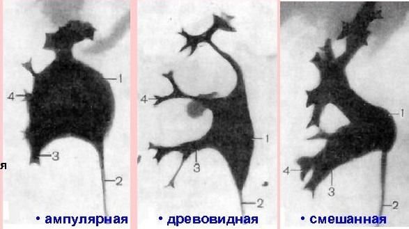 1- лоханка почки, 2 - мочеточник, 3- малая чашка, 4- большая чашка. Основные анатомические варианты строения лоханки. Малые чашки в количестве 6-12 образуют большую чашку, открывающуюся непосредственно в лоханку почки.