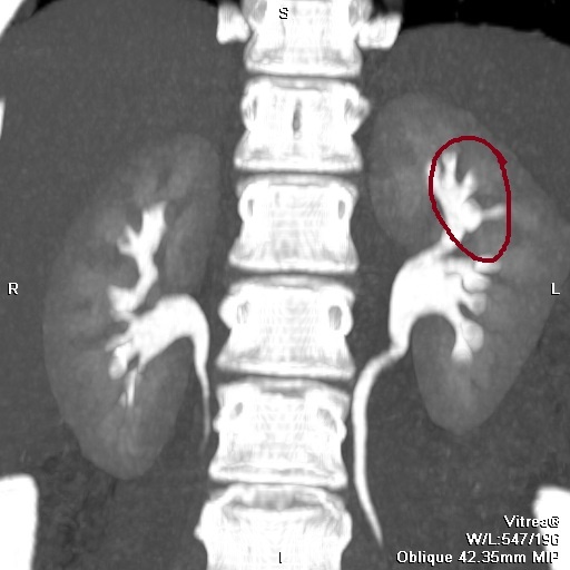 КТ ОБП в экскреторную фазу исследования: отчетливо визуализируется "отшнуровавшаяся" верхняя чашечка, иногда это называется дивертикулом чашки.