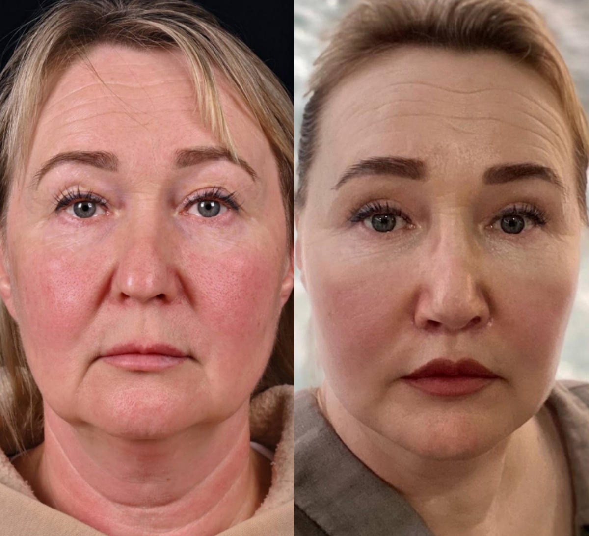 Пластика лица и шеи MACS-lift, омолаживающая ринопластика, пластика верхних век, трансконъюктивальная блефаропластика, липофилинг средней зоны лица, пластика верхней губы (булхорн). Фото до и после. Фото с сайта хирурга Д.Р. Гришкяна. Имеются противопоказания, требуется консультация специалиста