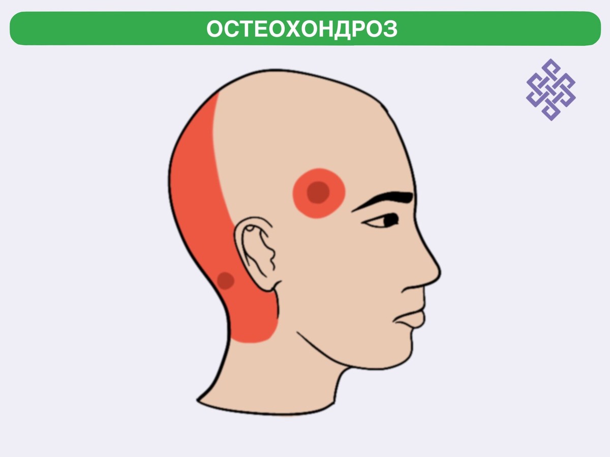 Остеохондроз
