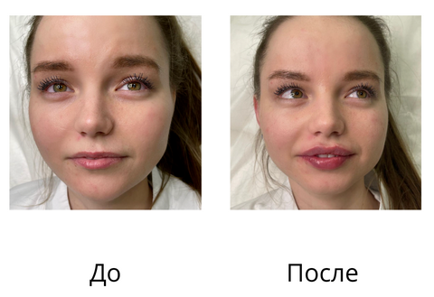 Коррекция губ. Процедуру выполнила врач-дерматовенеролог: Магомедова Пасихат, основательница сети клиник COSMOPRO.
