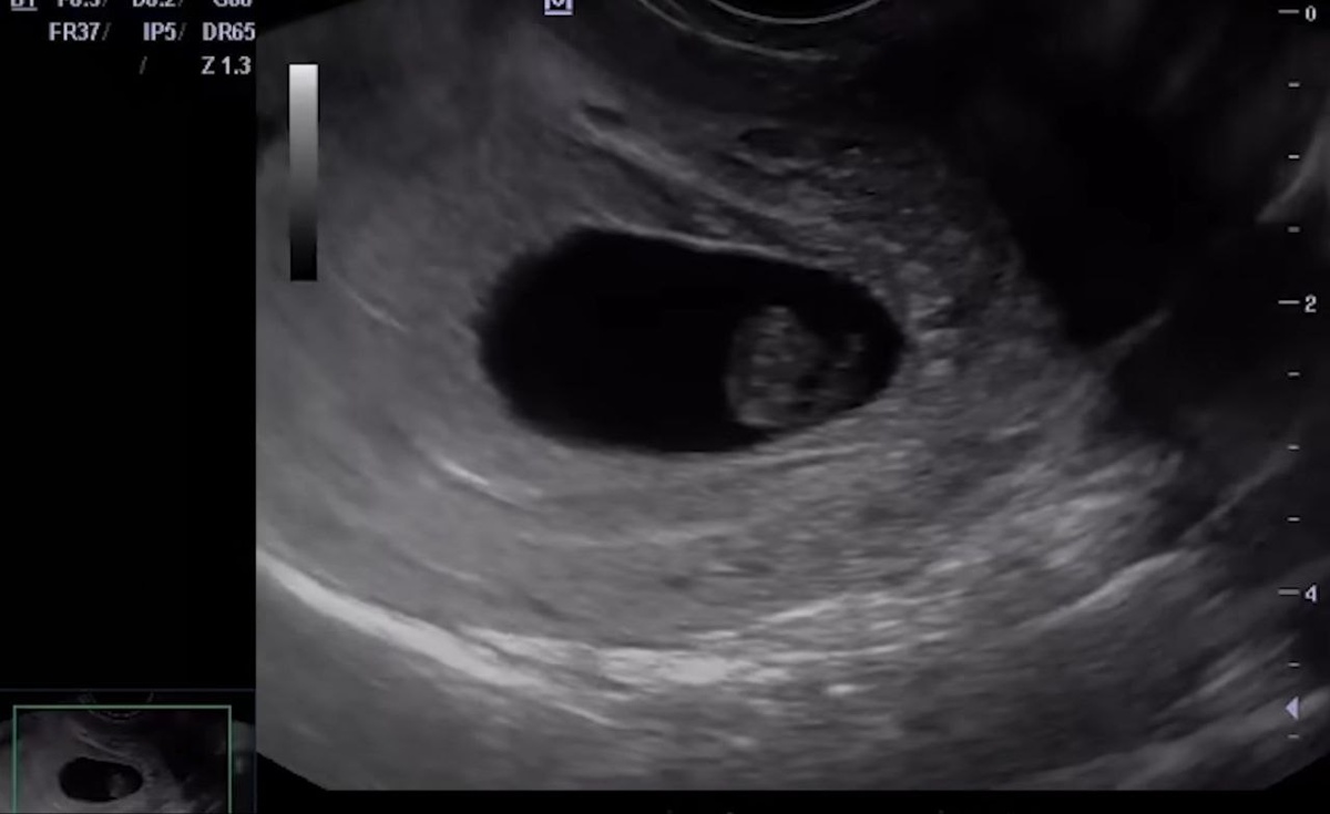 Фтография УЗИ Валентины