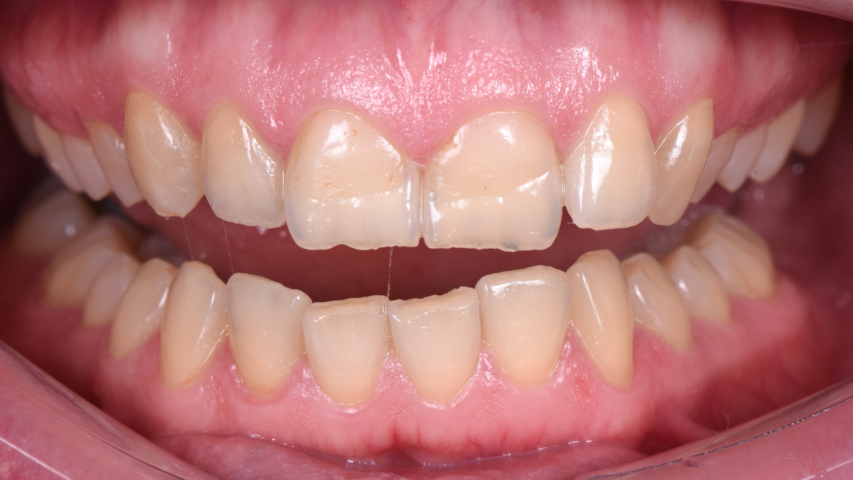 Исходная ситуация до ортодонтического лечения и художественных реставраций