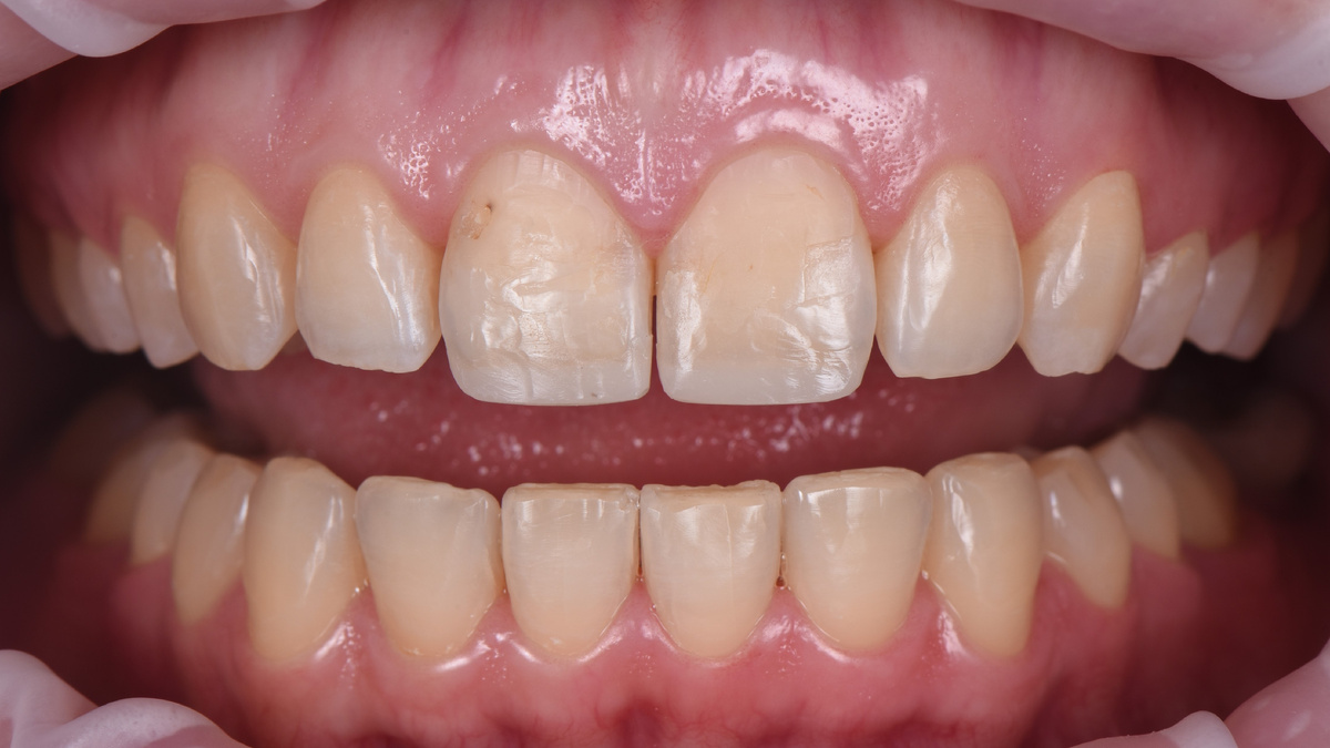 Ситуация в полости рта после ортодонтического лечения с временными художественными реставрациями на центральных резцах