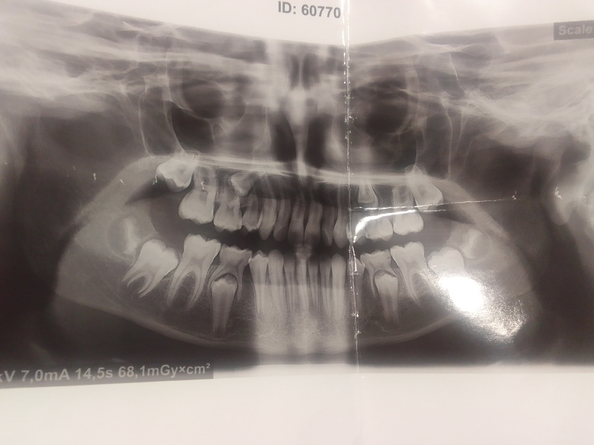 Зуб в зубе. Не ребёнок, а акуленок какой-то.