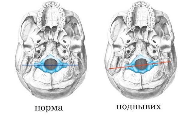 На рисунке изображено правильное и неправильное положение первого позвонка, если смотреть на череп снизу.