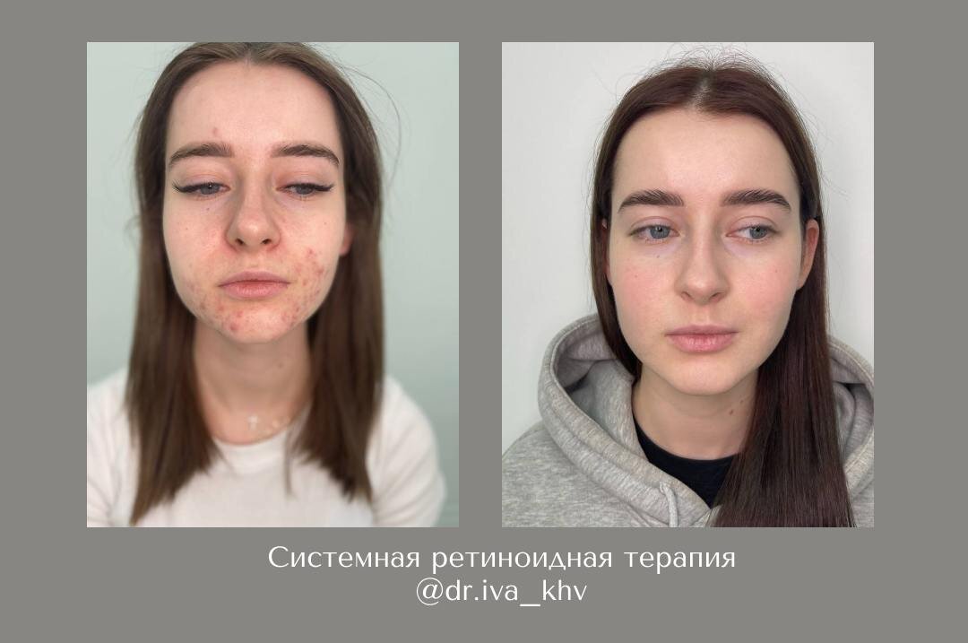 Окончательный результат пациента ✅

Сегодня еще одной красотке отменили системную терапию - курс лечения пройден полностью. Далее переход на местную поддерживающую терапию🧴