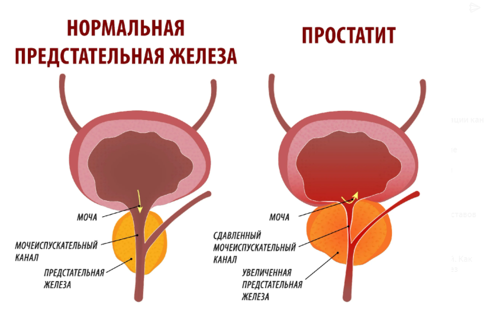 Аденома предстательной железы. Доброкачественная гиперплазия предстательной железы. Простата гиперплазия предстательной железы. Аденома карцинома предстательной железы. Доброкачественная гиперплазия предстательной железы протокол.