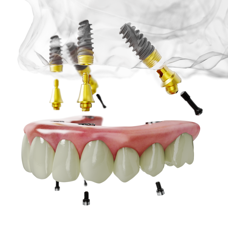 Технология All-on-4 на имплантатах Nobel Biocare