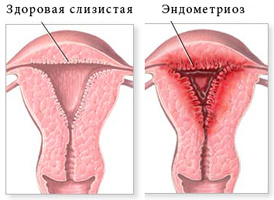 Эндометриоз матки. Аденомиоз.