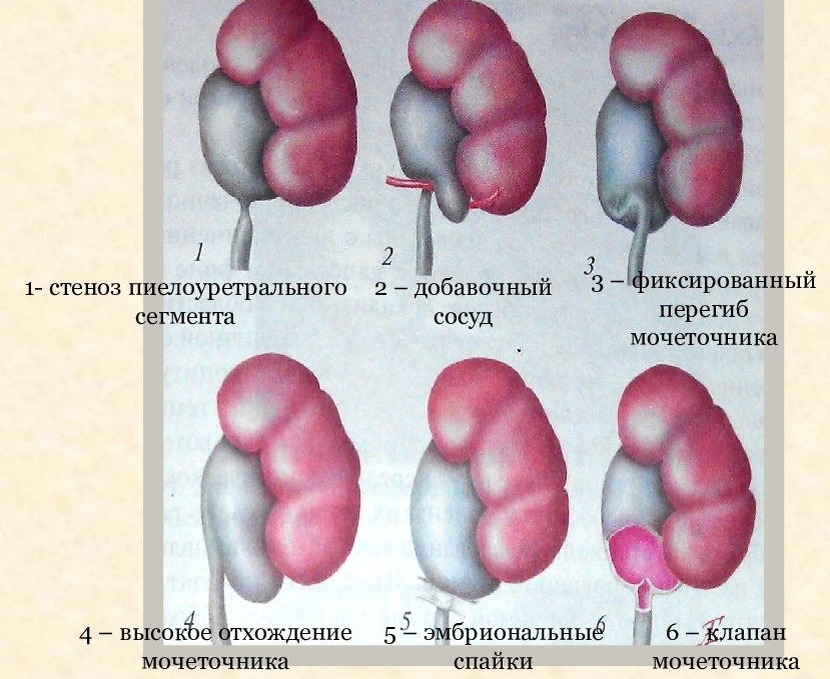 Здесь представлены основные врожденные причины, приводящие к развитию гидронефроза