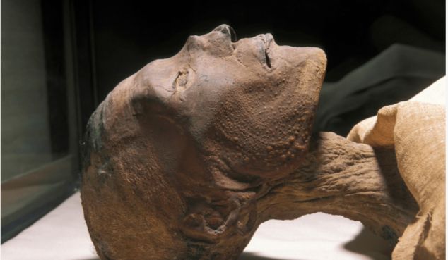 На коже видны следы оспенных пустул, а мумия Рамзеса считается достоверным археологическим подтверждением существования натуральной оспы в Древнем Египте