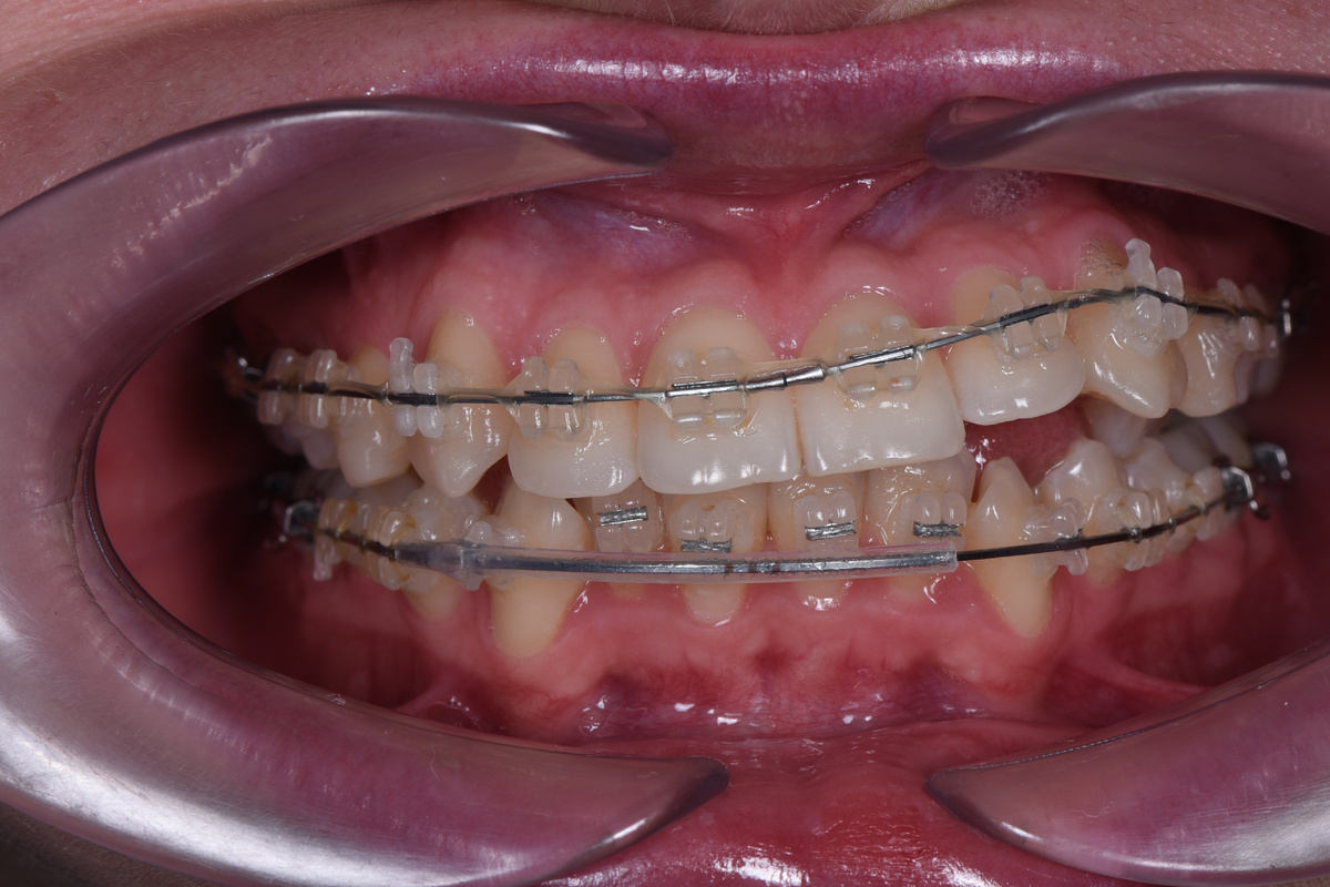При обращении к нам зубы пациентки выглядели так 