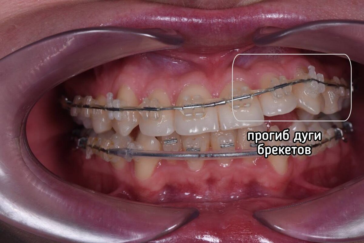 Прогиб дуги брекетов спустя полтора года лечения 