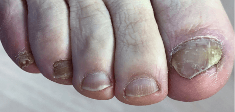 Грибок ногтей