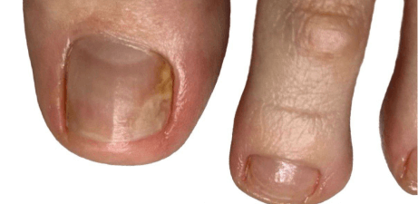 Онихолизис (отслойка ногтя от ногтевого ложа)