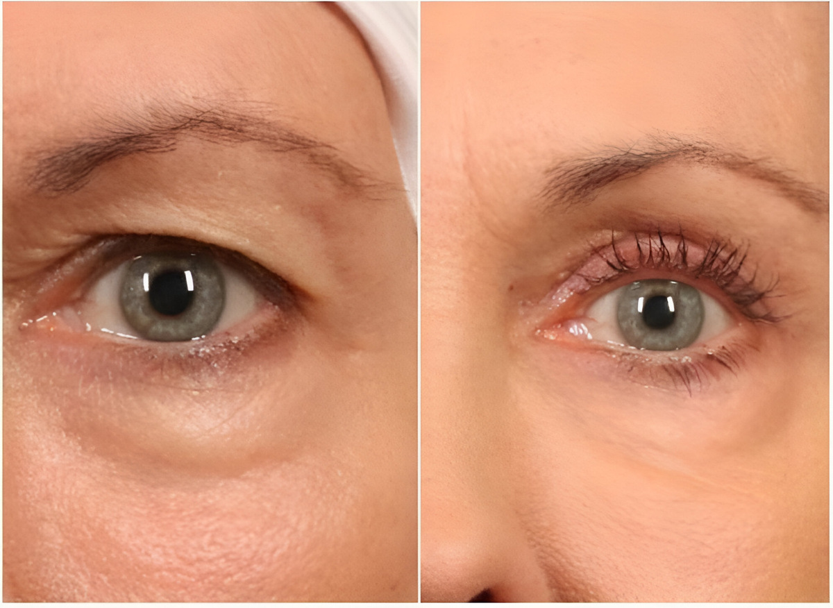 До/После мезотерапия