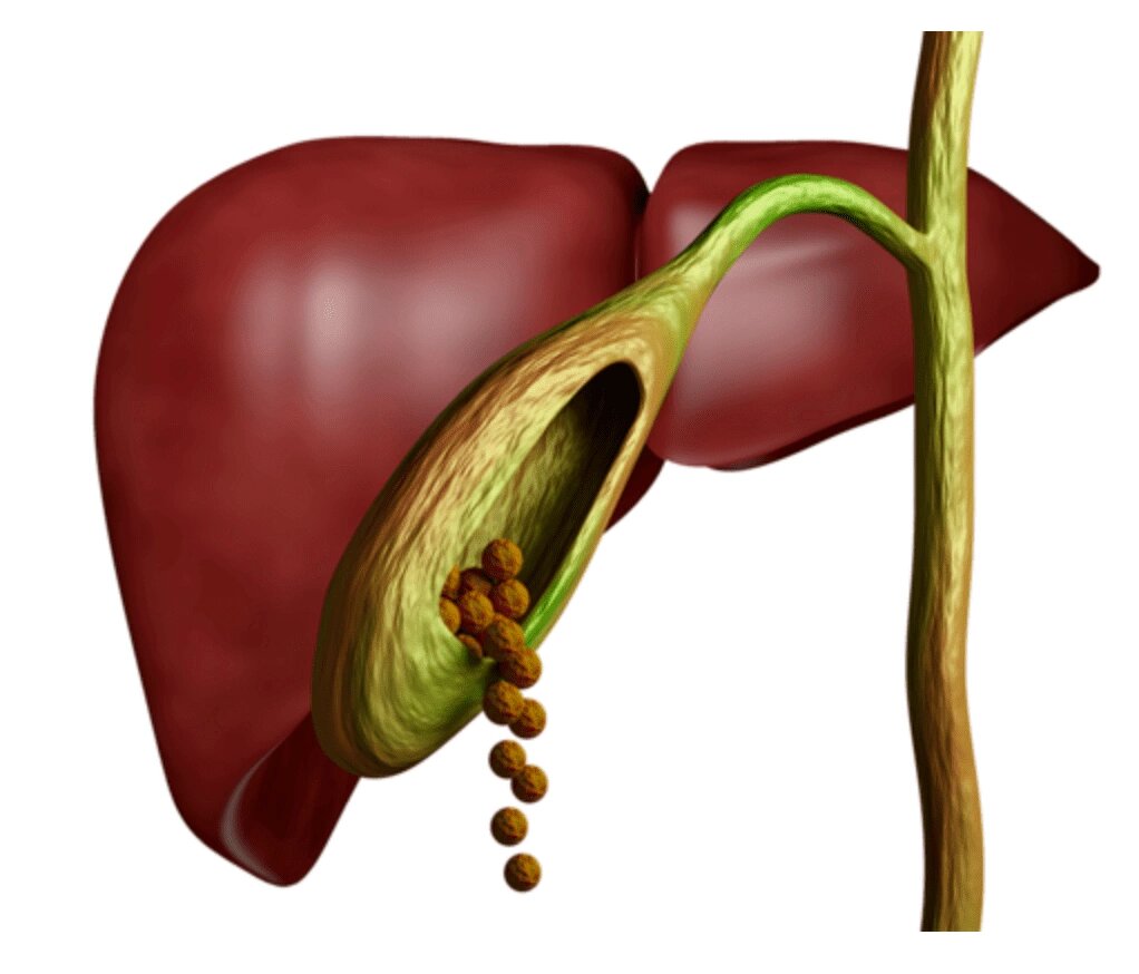 Камни в желчном пузыре