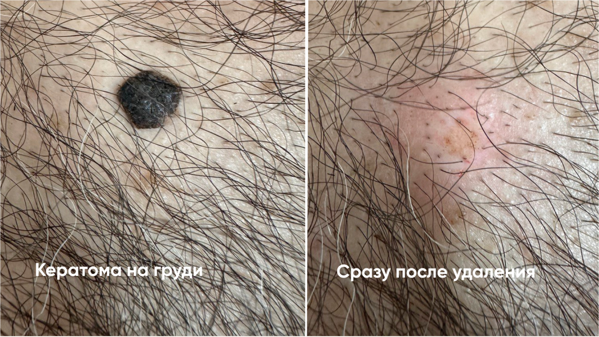 Лазерное удаление кератомы на груди: до и после