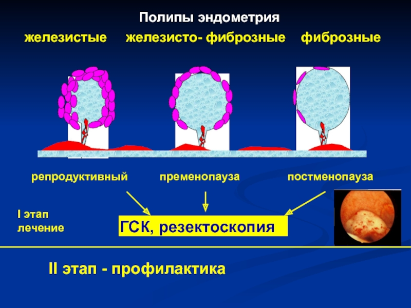 Железистый полип эндометрия гистология. Децидуальный полип эндометрия. Эхограммы полип эндометрия. Аденоматозные (железистые) полипы. Гиперплазия эндометрит.