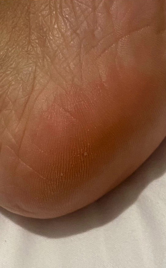 Мои пяточки в момент появления проблемы