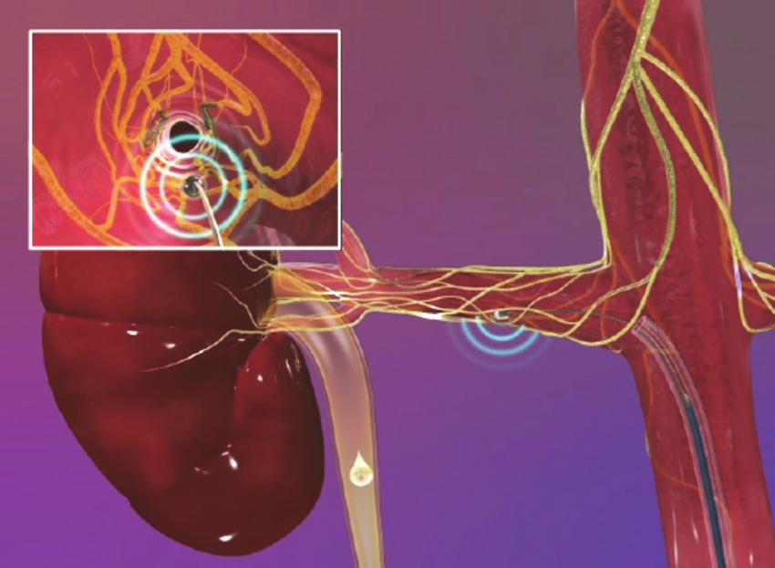 Изображение с сайта https://www.researchgate.net/ Схема денервации почечной артерии.