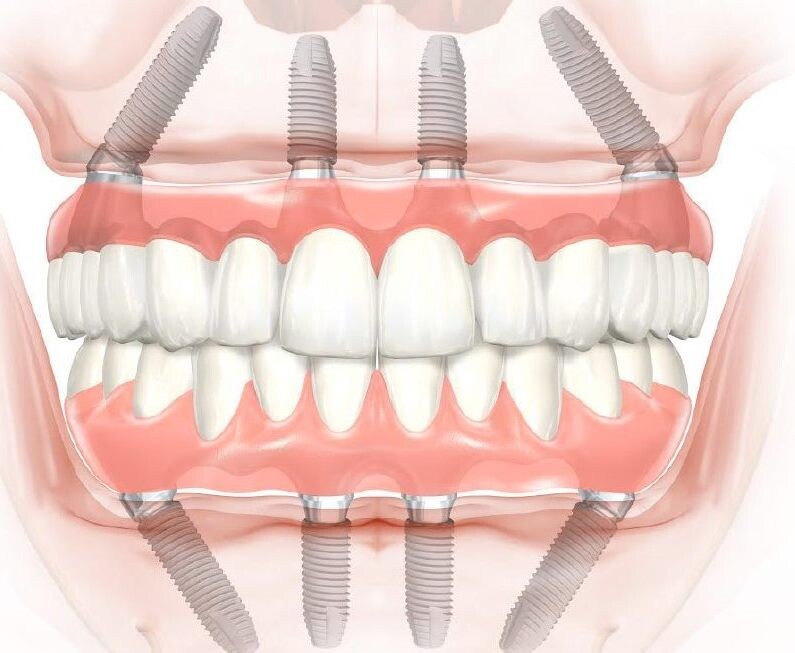 Так выглядят импланты и протезы All-on-4