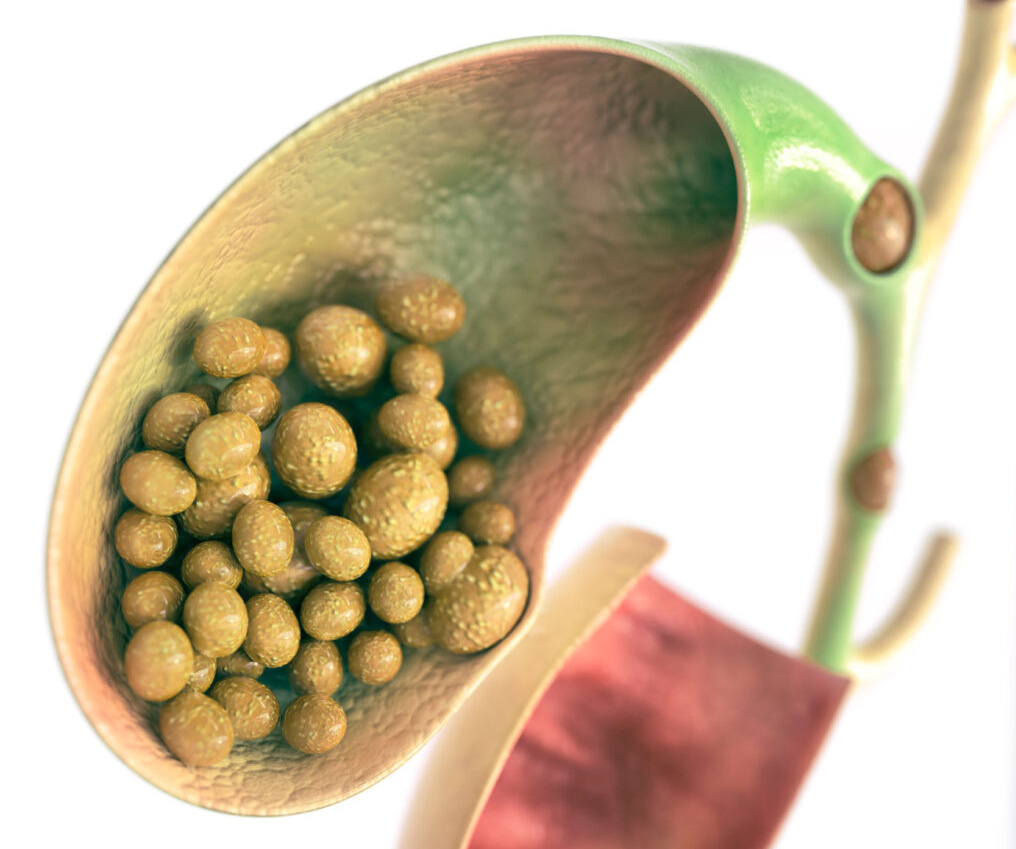 Камни в желчном пузыре и протоках