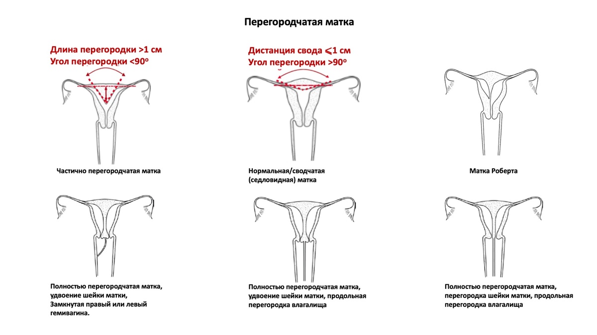 Рисунок 1. Диаграмма ASRM определяют нормальную/сводчатую (седловидную), септальную (перегородчатую) и бикорнуатную (двурогую) матку на основе оценки доступной литературы, понимая, что эти аномалии являются точками спектра развития.  
Нормальная/сводчатая (седловидная): глубина от интерстициальной линии до вершины углубления <1 см и угол >90о. 

Септальная (перегородчатая): глубина от интерстициальной линии до вершины углубления >1,0 см и угол углубления <90о. 
Наружный контур дна матки гладкий с углублением <1 см. 

ASRM. Mullerian Anomalies Classification. Fertil Steril 2021. 
ASRM - Американское общество репродуктивной медицины.