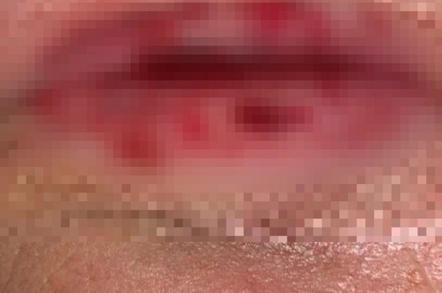    Последствия травмы - зрелище не для слабонервных. Фото:  Якутская республиканская офтальмологическая клиническая больница