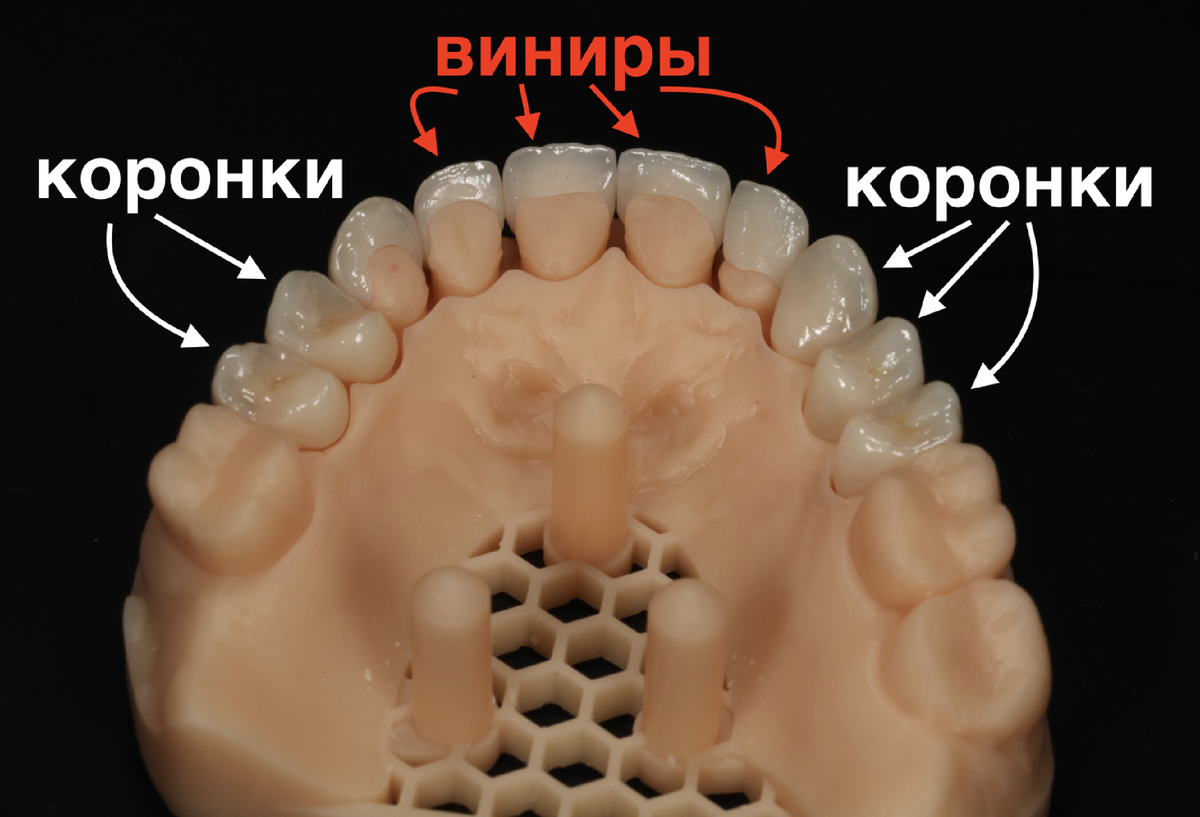 Коронки полностью закрывают коронковую часть зуба, виниры - нет. 