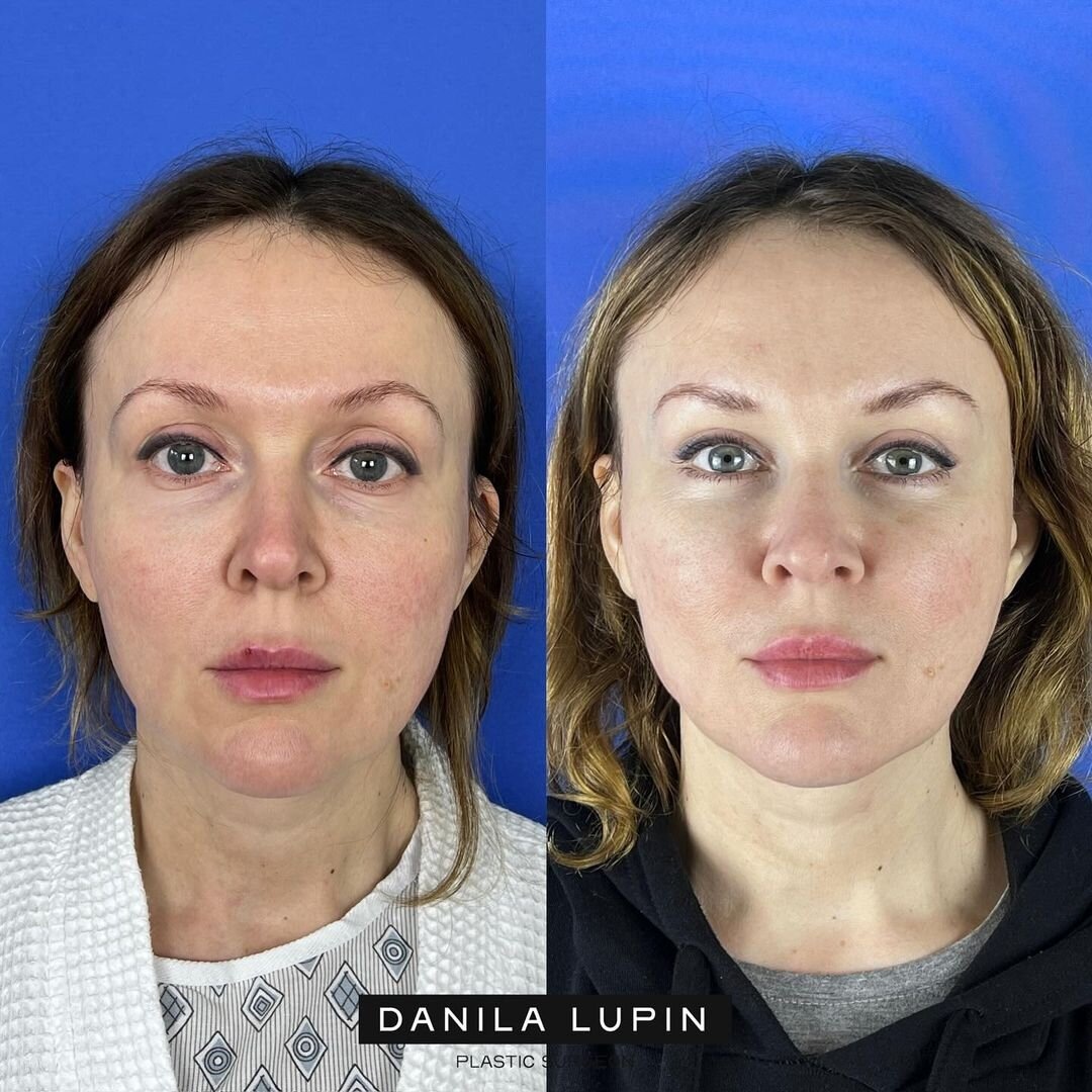 Эндоскопическая подтяжка лба, бровей, височной области и области средней трети лица. На фото пациентка Данилы Лупина. Имеются противопоказания, необходима консультация специалиста.