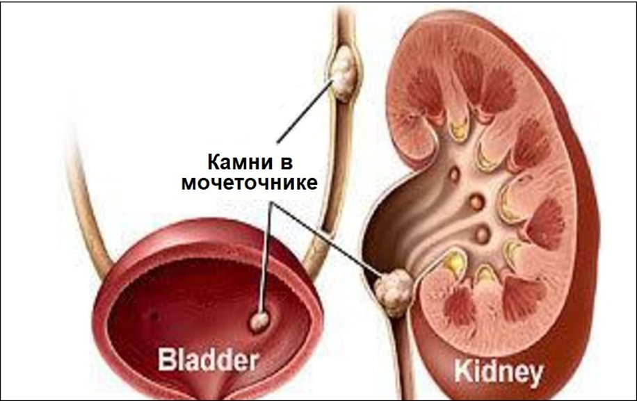 Камни блокирующие почку на разных уровнях мочевой системы