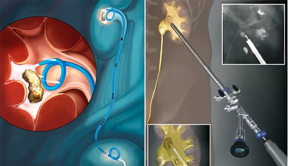 Стентирование мочеточника при почечных камнях