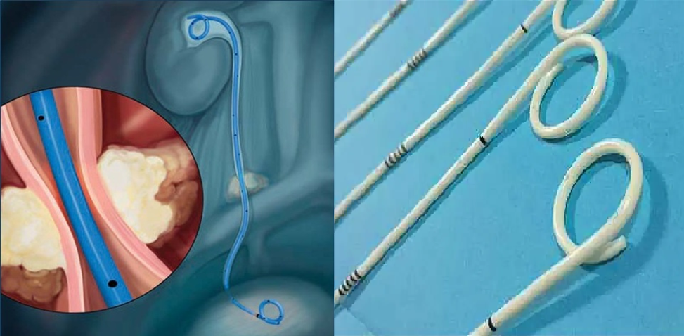Стентирование мочеточника при забрюшинных опухолях 