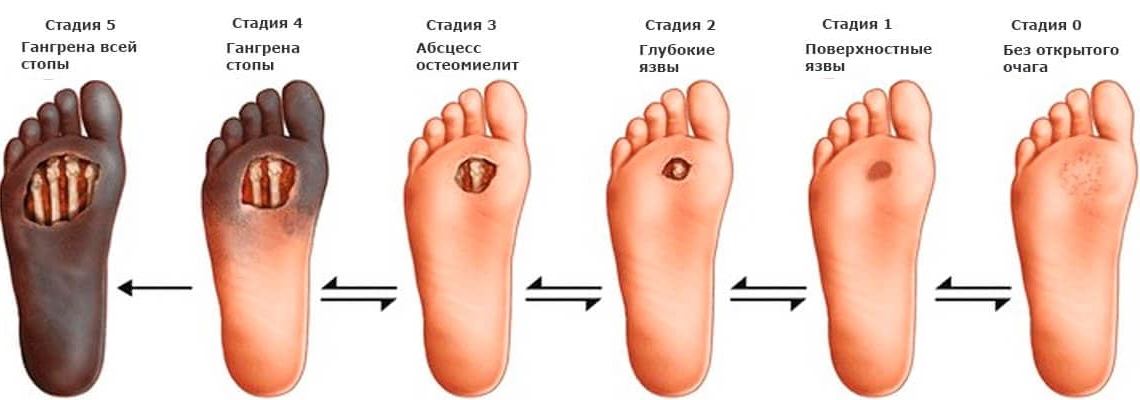 вы можете не заметить, как на пятке образовалась ранка, которая со временем станет язвой. А там уже недалеко до гангрены и (не дай Бог) ампутации