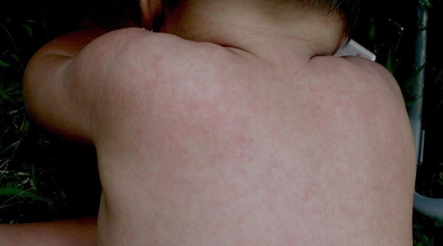    Экзантема Фото: Emiliano Burzagli, общественное достояние