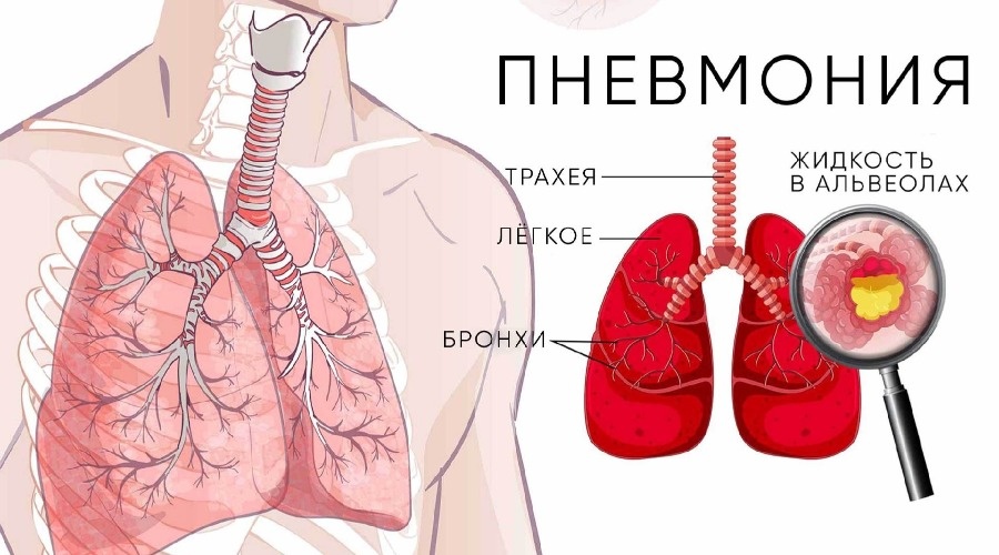  Пневмония: причины, симптомы и лечение

 Введение
Пневмония — это воспаление легких, которое может быть вызвано различными микроорганизмами, включая бактерии, вирусы и грибы. Это заболевание является одной из основных причин заболеваемости и смертности во всем мире, особенно среди детей и пожилых людей.

 Причины
Пневмония может развиваться по нескольким причинам:

1. **Бактериальная инфекция**: Наиболее распространенной причиной пневмонии является бактерия Streptococcus pneumoniae. Другие бактерии, такие как Haemophilus influenzae и Mycoplasma pneumoniae, также могут вызывать заболевание.

2. **Вирусная инфекция**: Вирусы, такие как вирус гриппа, респираторно-синцитиальный вирус (RSV) и коронавирусы, могут привести к вирусной пневмонии.

3. **Грибковые инфекции**: Грибки, такие как Pneumocystis jirovecii, могут вызывать пневмонию, особенно у людей с ослабленным иммунитетом.

4. **Аспирация**: Попадание пищи, жидкости или рвотных масс в легкие может вызвать аспирационную пневмонию.

 Симптомы
Симптомы пневмонии могут варьироваться от легких до тяжелых и включают:

- Кашель (может быть сухим или с выделением мокроты)
- Одышка или затрудненное дыхание
- Высокая температура и озноб
- Боли в груди, усиливающиеся при дыхании или кашле
- Усталость и общая слабость

 Диагностика
Для диагностики пневмонии используются различные методы:

- **Физикальное обследование**: Врач может прослушать легкие стетоскопом и обратить внимание на хрипы или другие аномалии.
  
- **Рентгенография грудной клетки**: Позволяет выявить воспаление в легких.

- **Лабораторные тесты**: Анализы крови и исследование мокроты могут помочь определить причину инфекции.

Лечение
Лечение пневмонии зависит от ее причины:

1. **Антибиотики**: Применяются для лечения бактериальной пневмонии.

2. **Противовирусные препараты**: Используются при вирусной пневмонии, если заболевание вызвано определенными вирусами.

3. **Противогрибковые средства**: Применяются при грибковых инфекциях.

4. **Поддерживающая терапия**: Включает отдых, обильное питье и, в некоторых случаях, кислородотерапию.

Профилактика
Профилактика пневмонии включает:

- Вакцинацию против пневмококковой инфекции и гриппа.
- Своевременное лечение простудных и респираторных заболеваний.
- Поддержание здорового образа жизни, включая правильное питание и физическую активность.

 Заключение
Пневмония — серьезное заболевание, которое требует внимания и своевременного лечения. При возникновении симптомов, таких как кашель, одышка и высокая температура, важно обратиться к врачу для диагностики и выбора адекватной терапии.