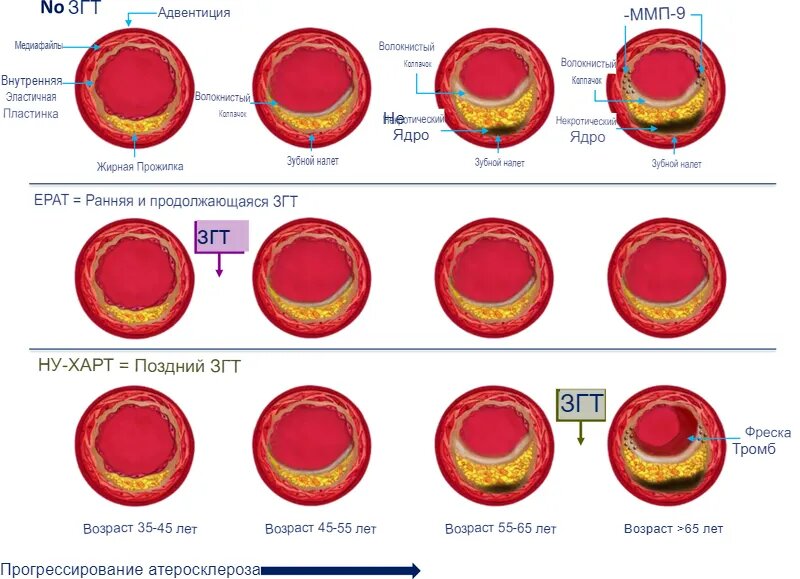 Раннее начало заместительной гормональной терапии (ЗГТ) и ее продолжение, пока эндотелий не поврежден, поддерживают здоровье сосудов и замедляют их старение и прогрессирование атеросклероза (5). С другой стороны, ЗГТ, начатая на поздней стадии атеросклероза, не влияет на уже имеющиеся сосудистые заболевания