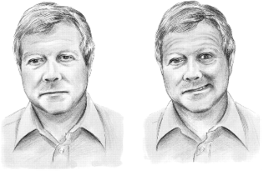 Несимметричная улыбка – один из признаков инсульта