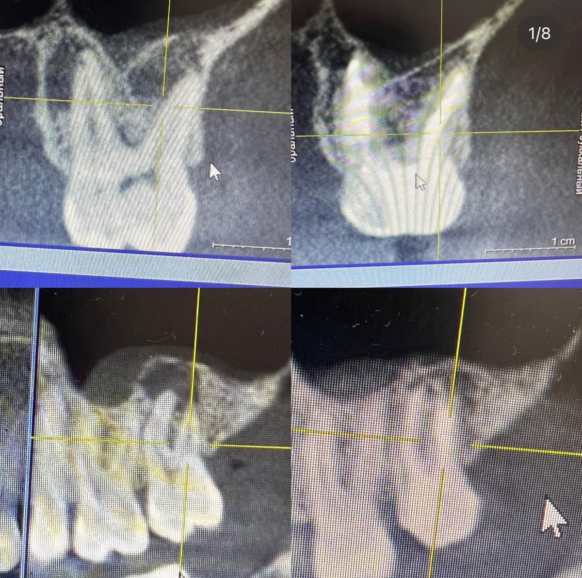 «Динамика заживления - 5 месяцев.» 