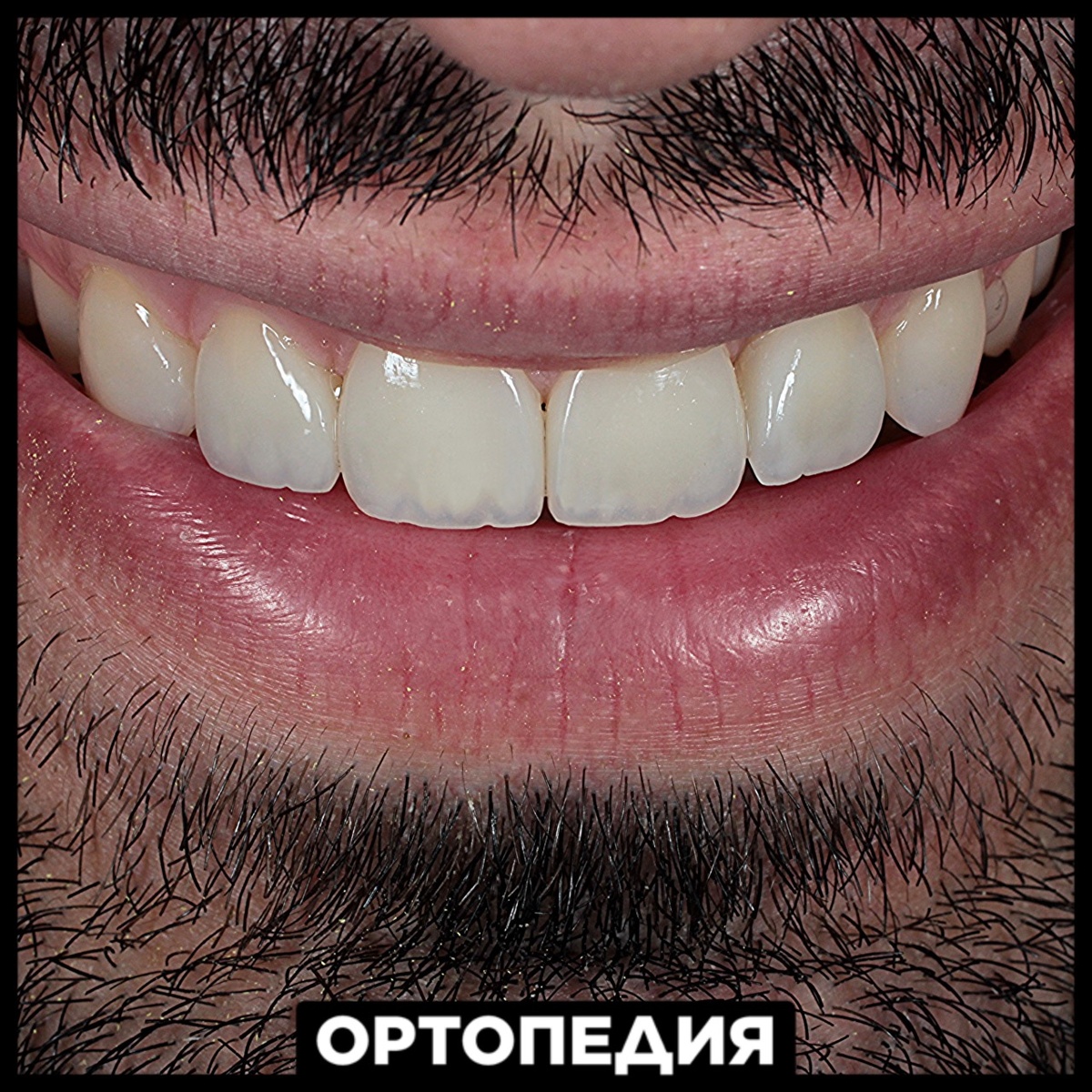 Композитные виниры 