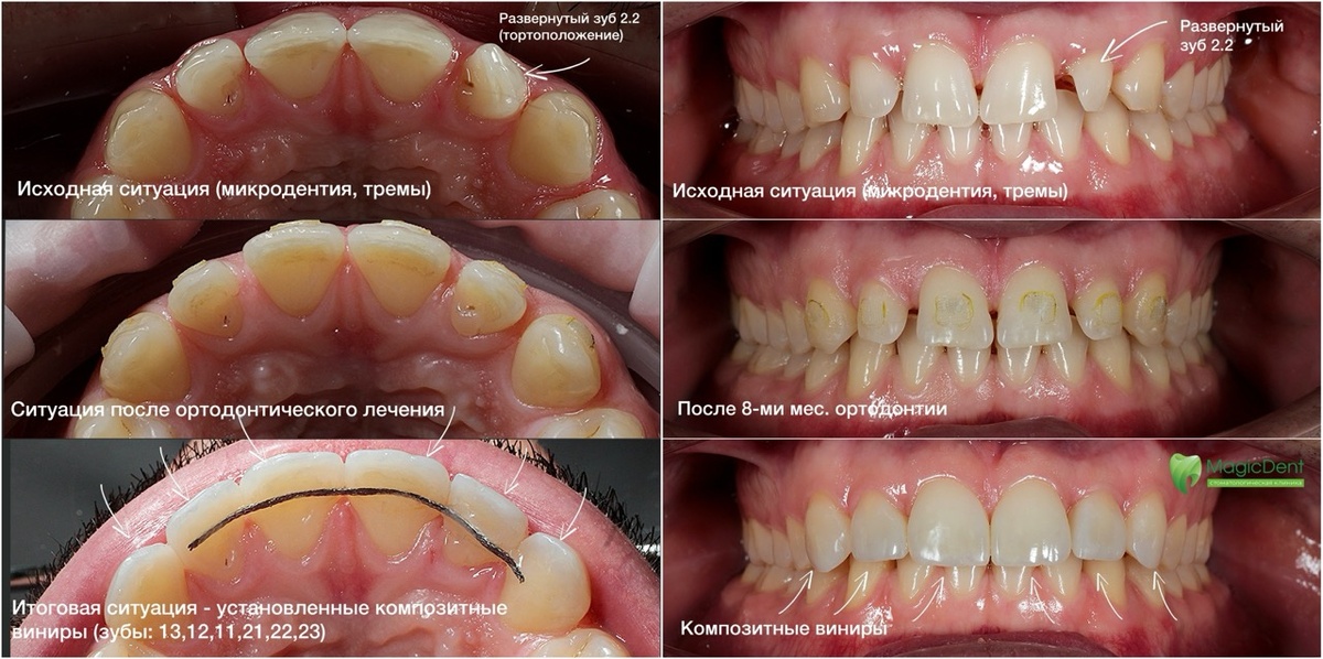 Процесс лечения - от ортодонтии к композитным винирам