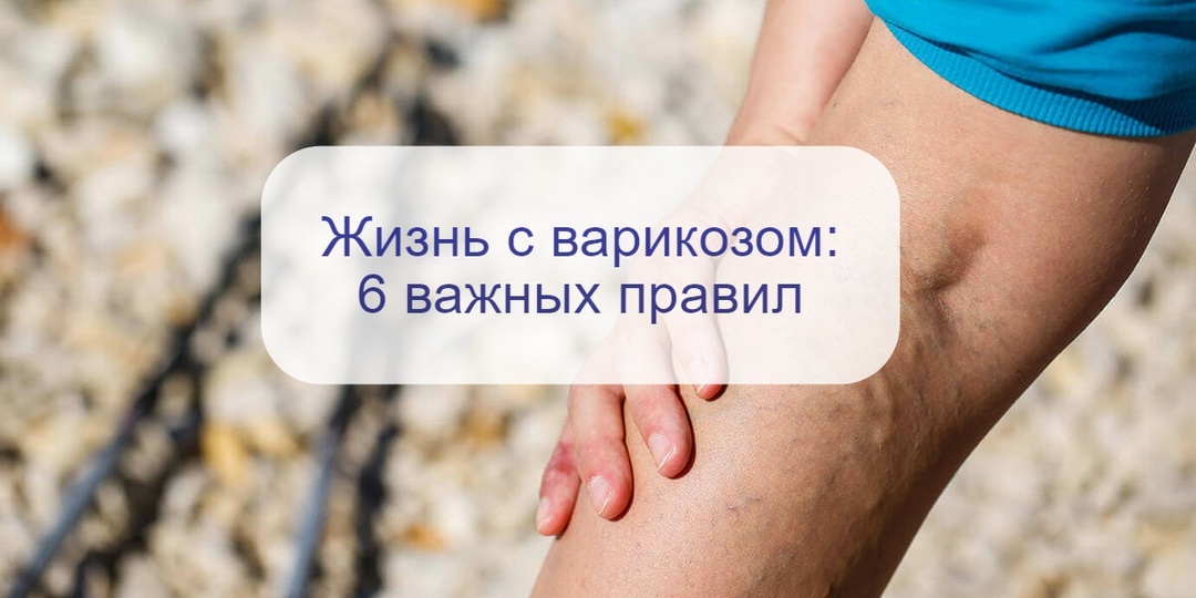 Что нельзя делать при варикозной болезни: врач перечислила 6 простых правил