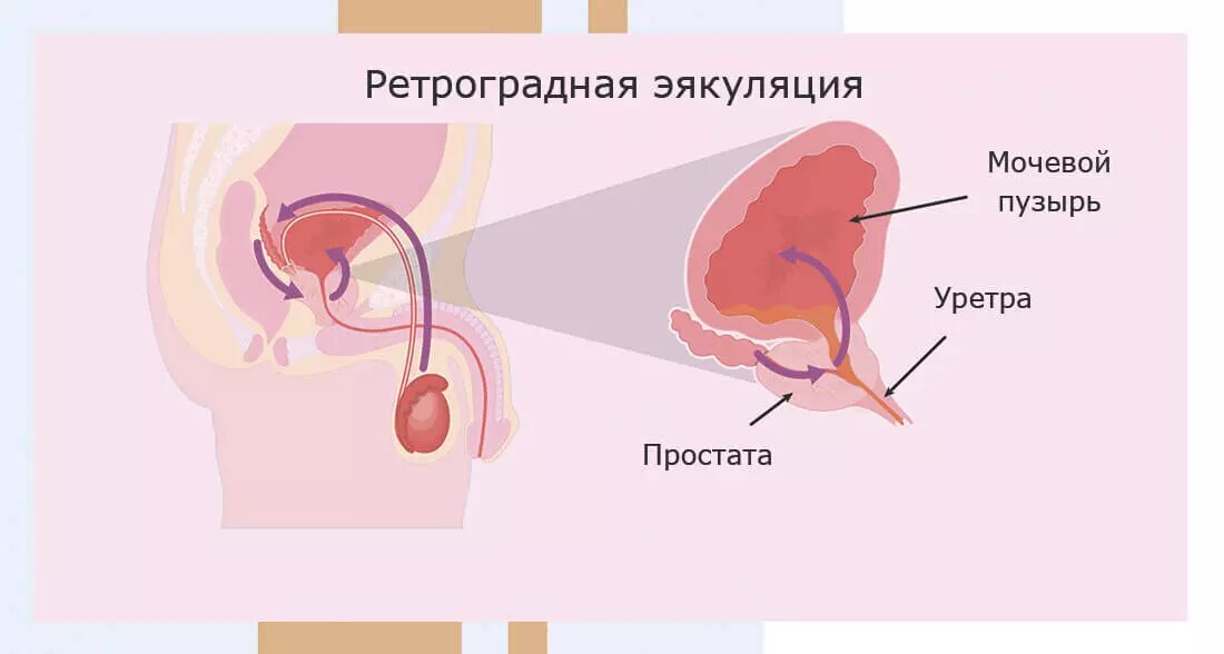 Сперма попадает в мочевой пузырь