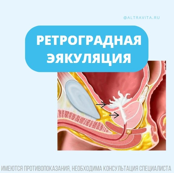 Ретроградная эякуляция
