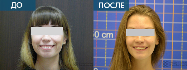 Исправление прикуса у взрослого пациента ДО и ПОСЛЕ