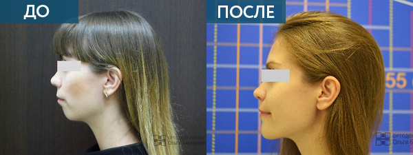 Исправление прикуса у взрослого пациента ДО и ПОСЛЕ