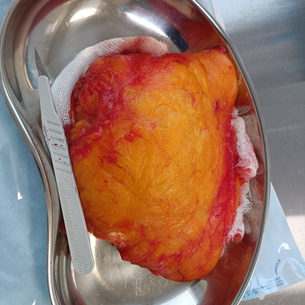 Пациентке была удалена липома бедра больших размеров под местной анестезией в поликлинических условиях. Операция заняла около 1часа. Послеоперационный период без осложнени. Швы сняты на 14 е сутки.