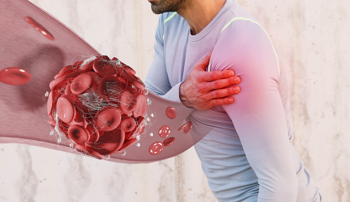 Образование тромба (источник изображения: freepik.com)